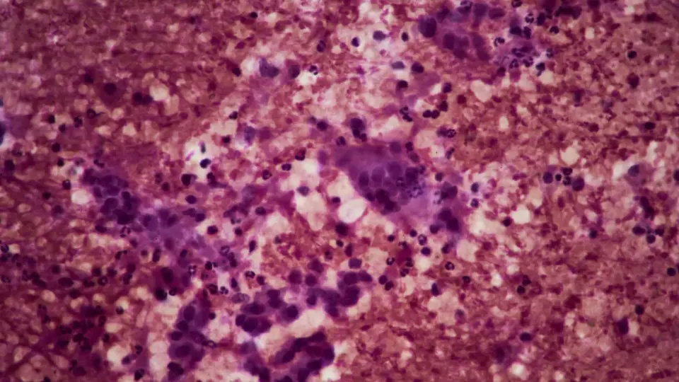 Tango Therapeutics reports 82% response rate for chemo-free pancreatic cancer combo at ESMO