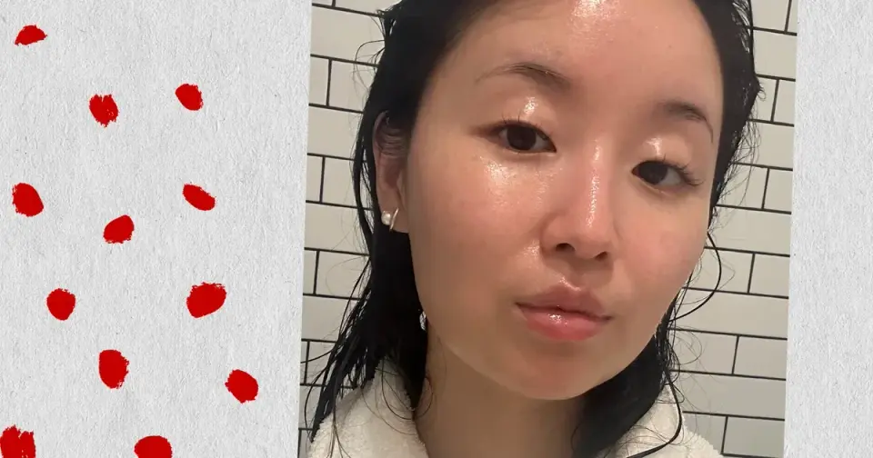 Accutane Isn’t a Nose Job, It Just Clears Acne and Can Make the Nose Look Sleeker