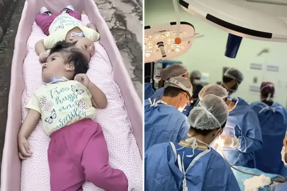 Brazilian Conjoined Twins Die Minutes After Final Separation Surgery