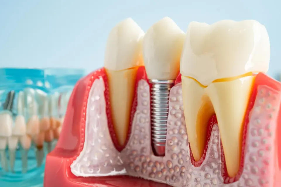Titanium Particles Trigger Immune Chaos in Dental Implant Infections