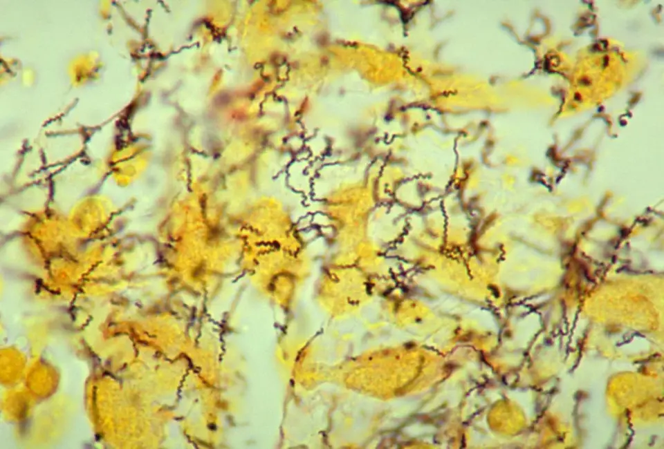 Treponema Clue Offers New Start Point for Noma Treatment