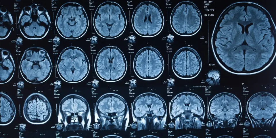 Childhood Trauma May Rewire Brain Networks That Fuel Procrastination in Adulthood