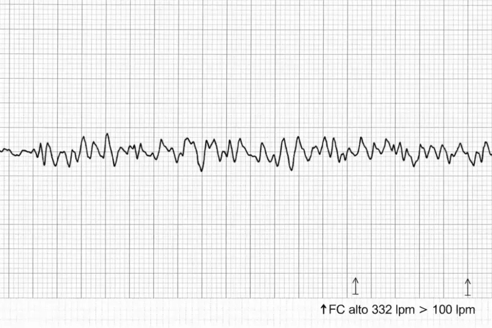 Perimyocarditis Triggers MINOCA and Sudden Cardiac Arrest in a Healthy Young Man