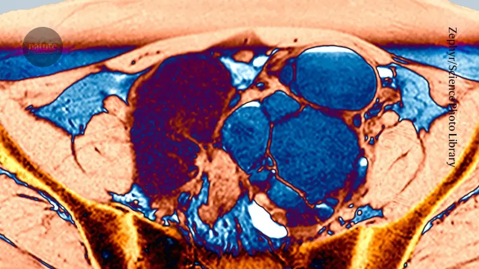 Nanotherapy Delivers Tapeworm Drug to Endometriosis Cells in Mouse Trial