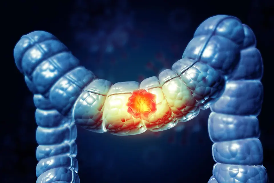 Early Warning: Surgeons Urge Attention to Colorectal Cancer Symptoms in Younger Adults