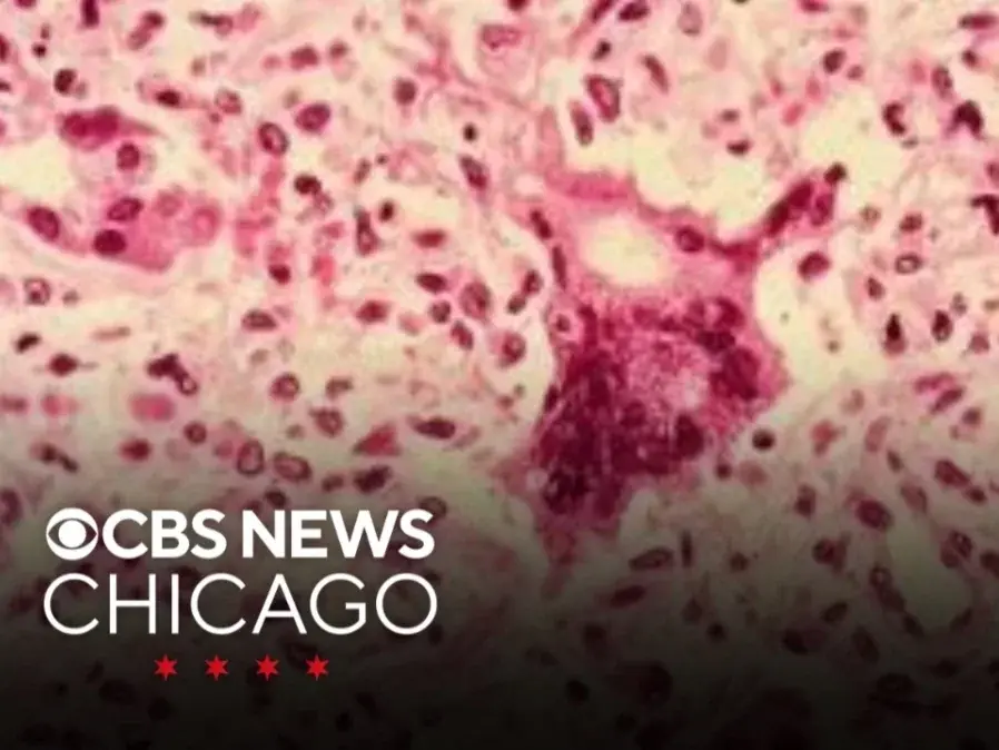 Measles Exposure Alert Issued for O’Hare Terminal 5