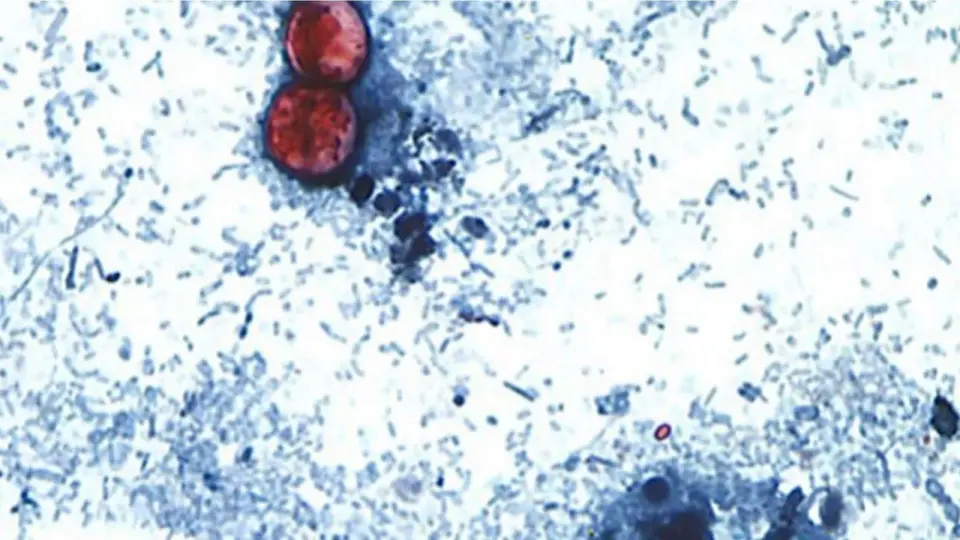 Cyclospora outbreak tied to iceberg lettuce tops 24,000 cases as spread slows