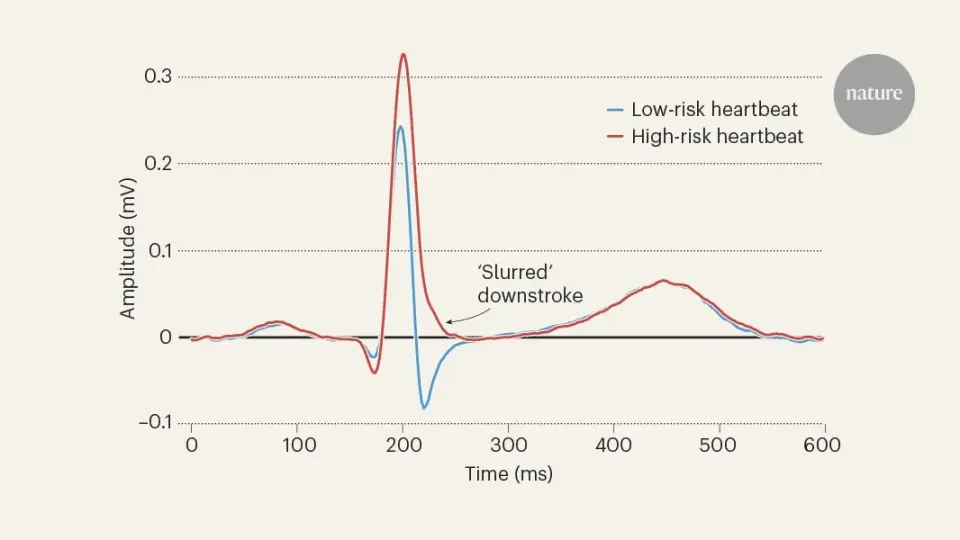 AI-powered ECG clues reveal hidden risk group for sudden cardiac death