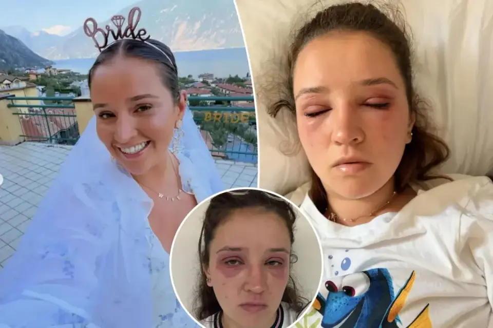 Bride-to-be nearly blinded by eyelash extension scare before wedding