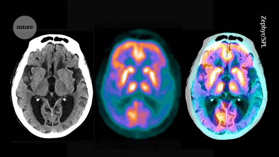 Atlas of brain microproteins offers new angles on Alzheimer’s