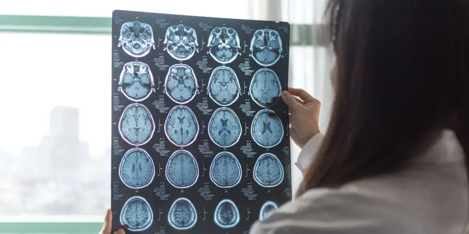 Migraines May Accelerate Brain Aging in Memory and Emotion Regions
