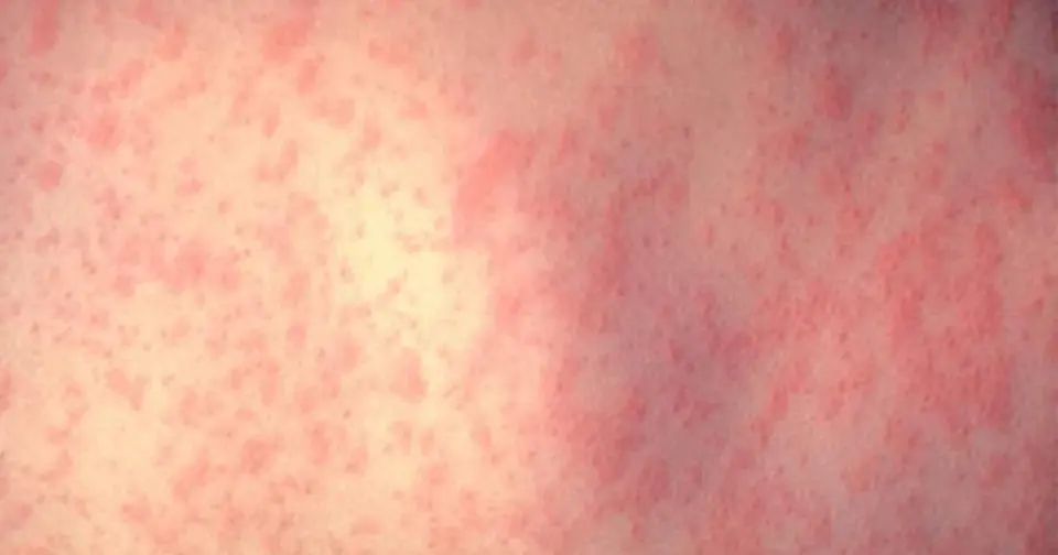 Traveler-linked measles exposure prompts Denver area alert