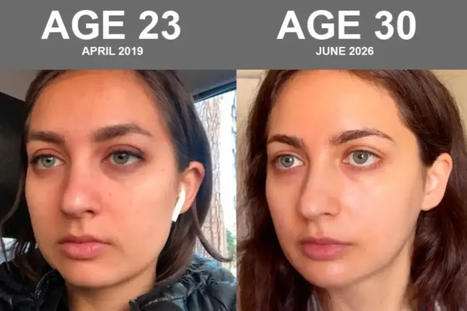 Biohacking girlfriend claims skin age is 21 at 30 after science-led regimen