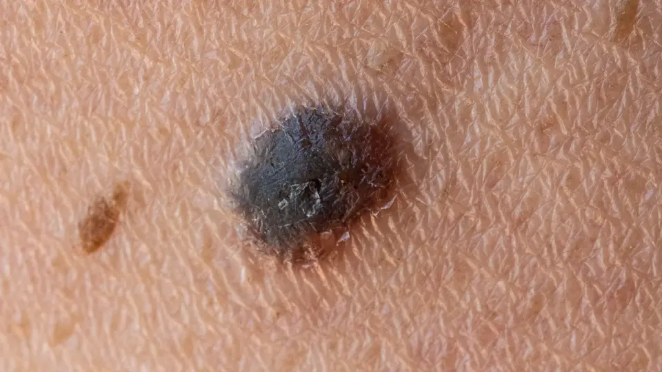 Personalized mRNA Vaccine Shows 42% Drop in Melanoma Recurrence in Phase 3 Trial